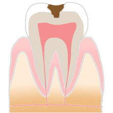 むし歯画像1