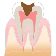 むし歯画像2