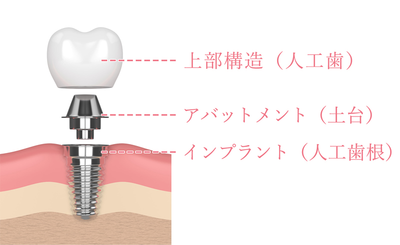 画像:インプラント